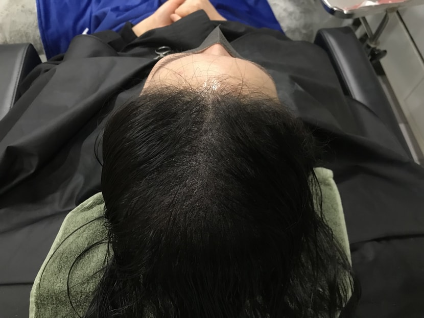 시술후