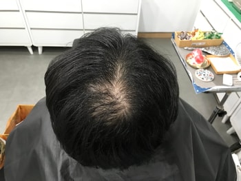 시술 전 물 묻은 상태