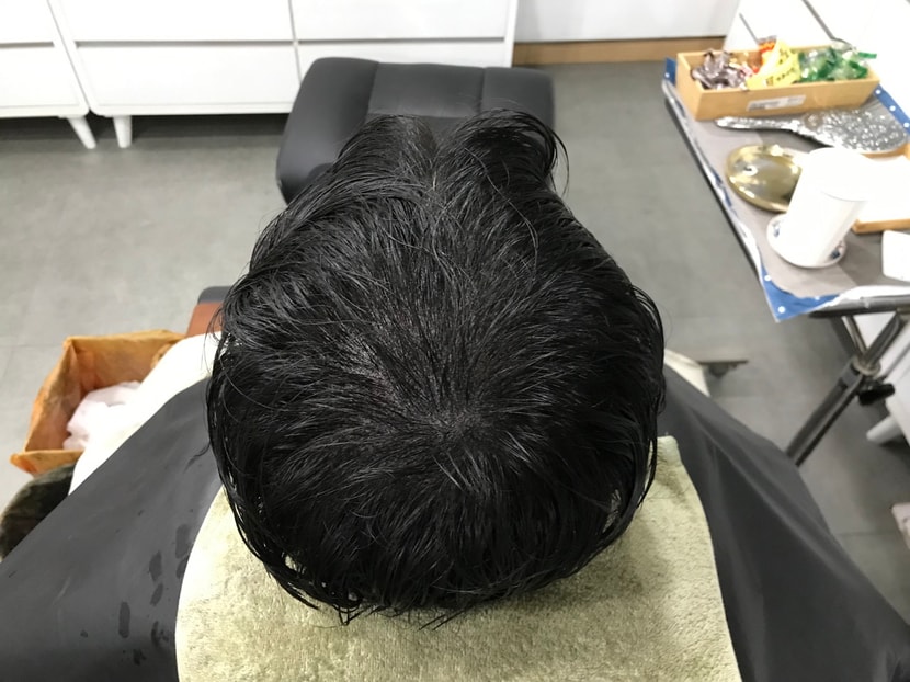 시술 직후