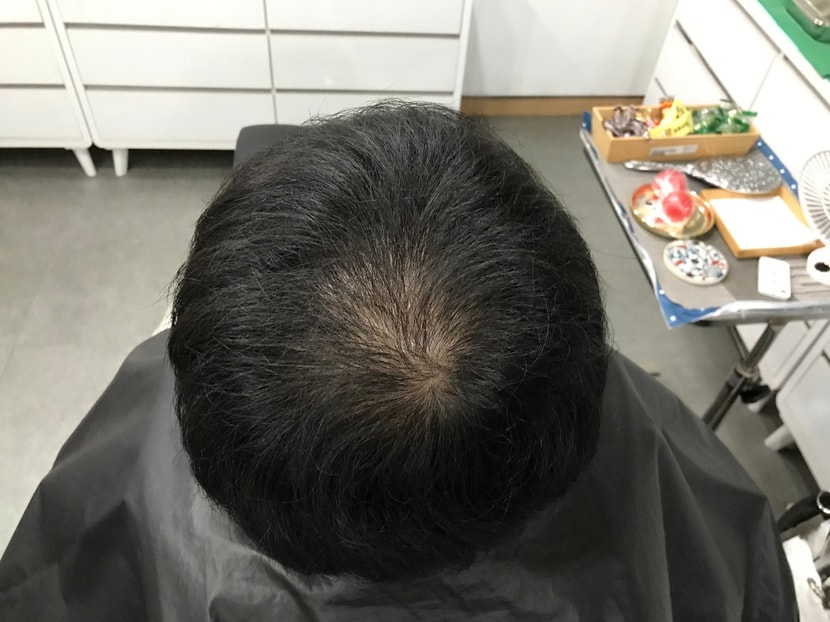 시술 전 
