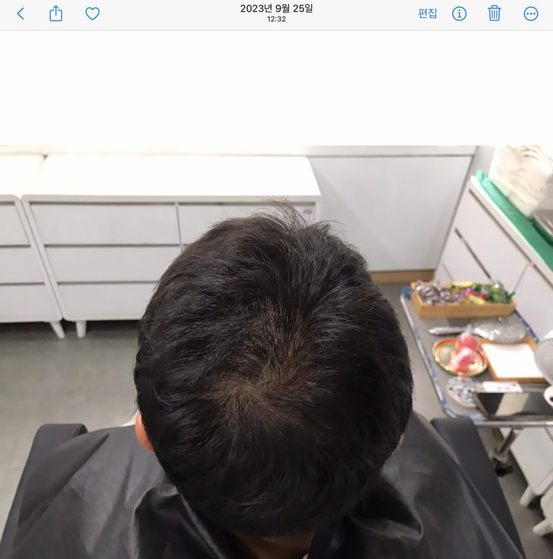 Yonsei Midain Clinic纹头皮3年后期