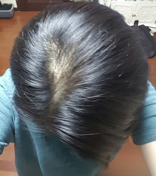 这是头皮纹身第二次后记。