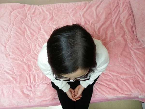 Dana头皮纹身手术1个月后,修复完毕!