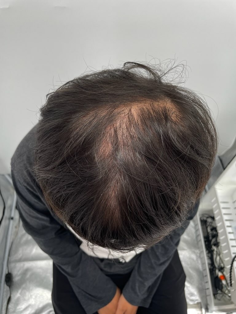 강남 뉴헤어 모발성형외과 두피문신(3차) 완료했습니다.