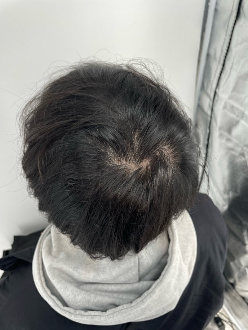 江南站新发型医院头皮纹身3次后期