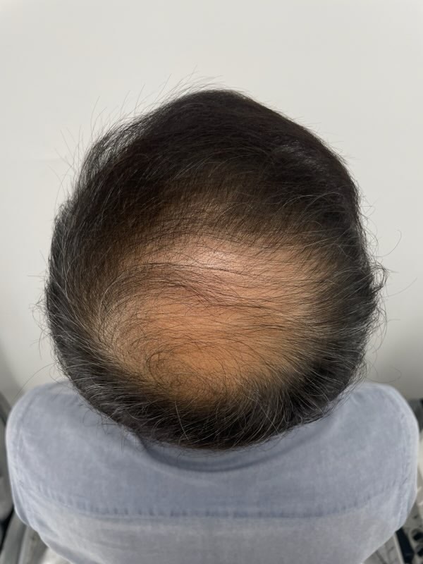 정수리 문신 받았는데 만족도가 높아요. 헤어 타투는 뉴헤어 강남으로 추천드려요