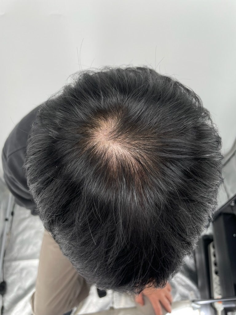 在江南头皮纹身医院NEWHAiR 植发中心接受头顶手术的后记