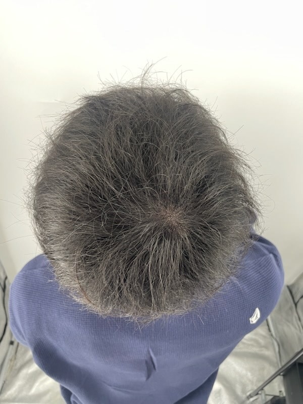 강남 두피문신병원 후기 정수리 두피문신 뉴헤어성형외과에서 받았습니다 아직 1회 남았어요