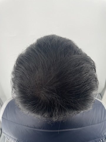 두피문신 해야하는 이유. 빠를수록 좋다 강남 뉴헤어!!