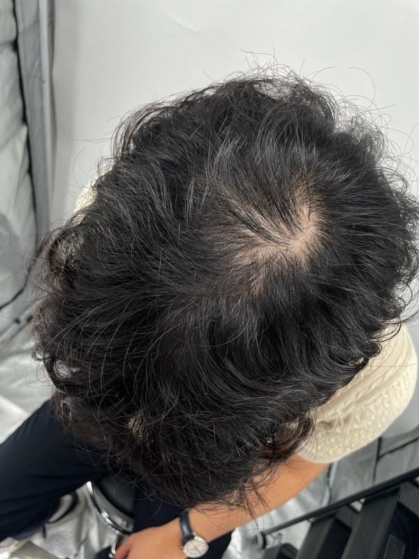 정수리 가르마 잘하는 강남 뉴헤어성형외과 두피문신 후기! 두피문신은 두피문신병원에서