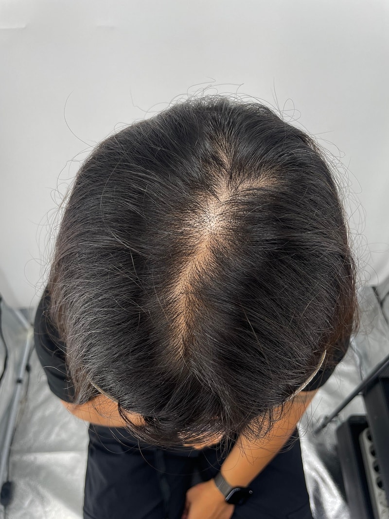 头皮纹身手术比想象中要自然，周围也完全看不出来。 江南我们村的脱发医院 NEWHAiR 植发中心后期