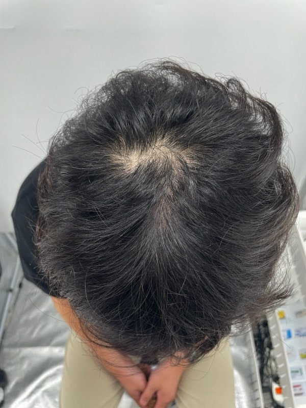 두피문신으로 자신감 회복했습니다