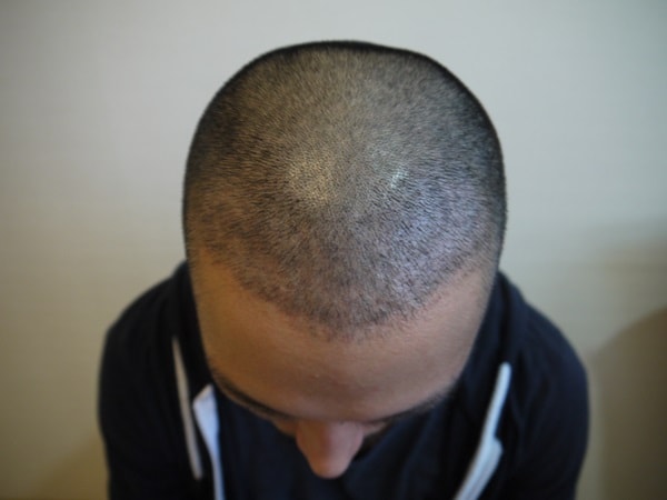 几乎时隔一年了...头皮纹身1年后上传后记。