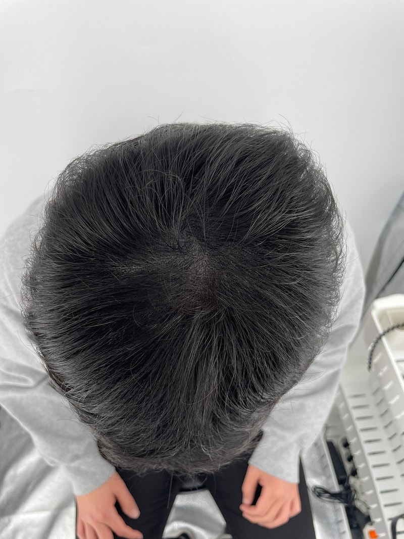 강남 뉴헤어 두피문신 시술 마치고 왔습니다 ^^ 헤어타투는 뉴헤어