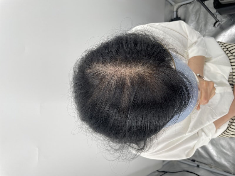 第二次头皮纹身 我很满意^^ 江南头皮纹身医院NEWHAiR 植发中心后记