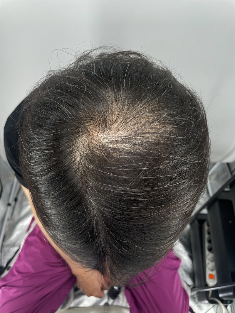 NEWHAiR 植发中心第二次头皮纹身果然是头皮纹身医院！ 江南的头皮纹身在这里
