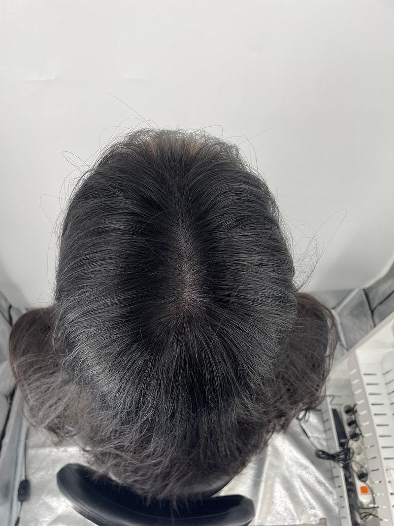 강남 뉴헤어에서 두피문신 시술 받았습니다