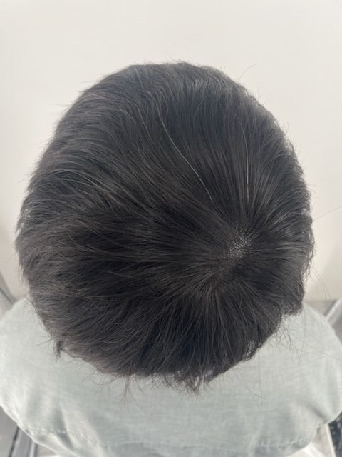 유튜브 보고 두피문신 고민하다가 시술받음 뉴헤어 추천