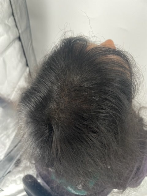 강남 뉴헤어모발성형외과에서 두피문신후기