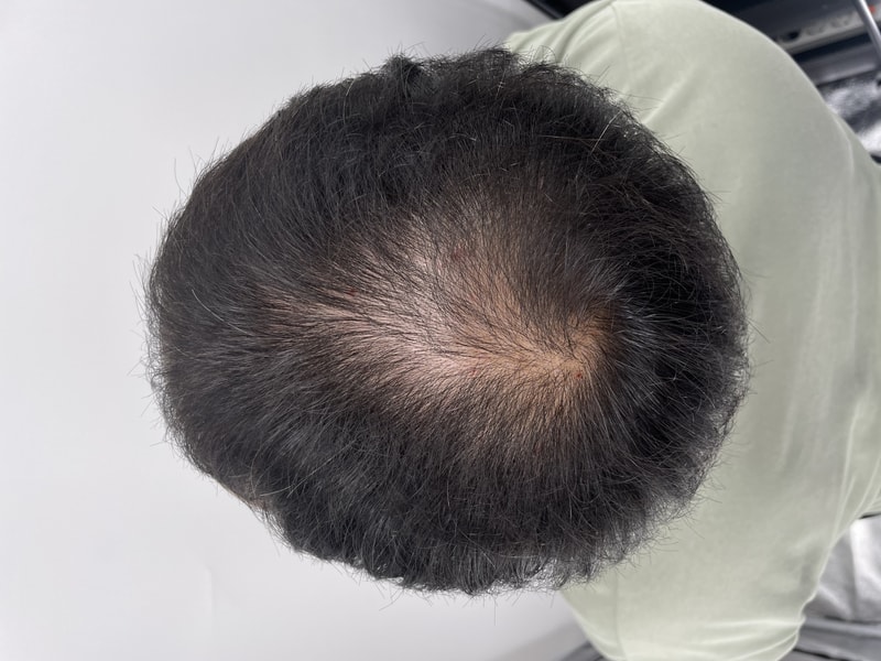 在江南收到了男士头顶头皮纹身NEWHAiR 植发中心。 我们村的脱发医院推荐后记