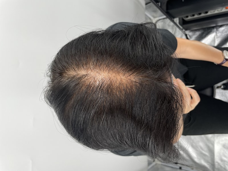 頭皮タトゥー2回 江南ニューヘアー 体験談^^ 仁川から来ました。 薄毛クリニックおすすめ