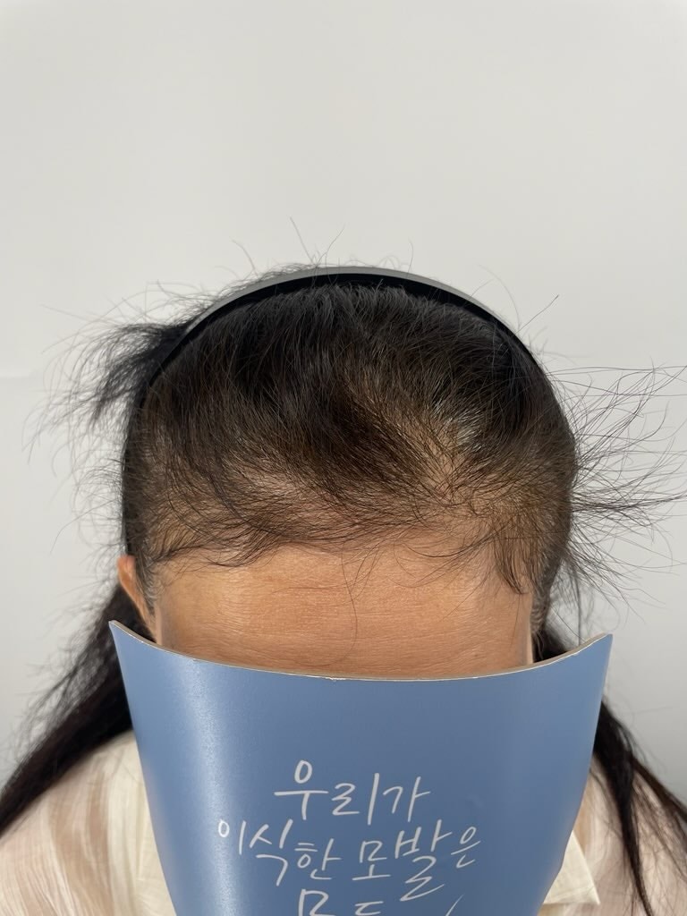 거울 볼 때마다 이마가 넓어 보여서 늘 신경 쓰였는데, 이제는 훨씬 자연스러워요.