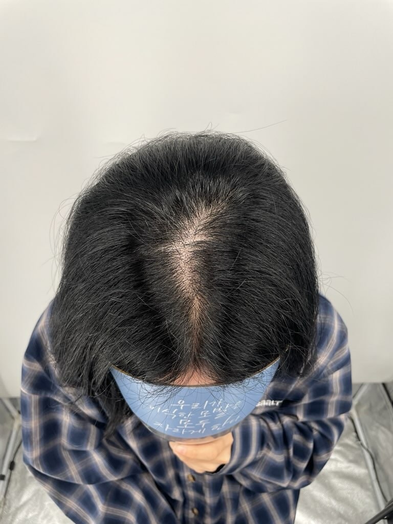 가르마가 점점 넓어져서 고민이 많았는데, 강남 뉴헤어성형외과에서 두피문신으로 자연스럽게 커버가 되었어요.