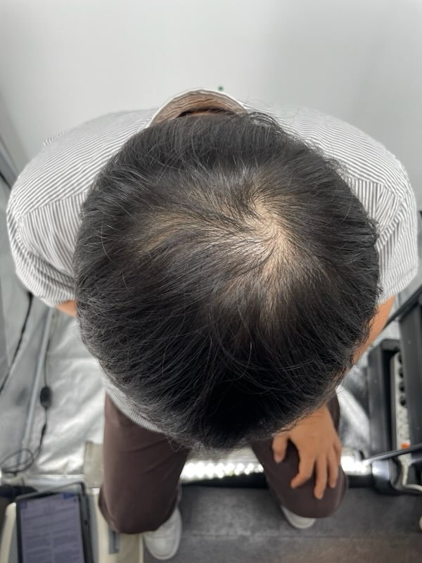 정수리 탈모로 고민이 많았는데 강남 뉴헤어성형외과 두피문신병원에서 두피문신 받고 훨씬 자연스러워졌어요.