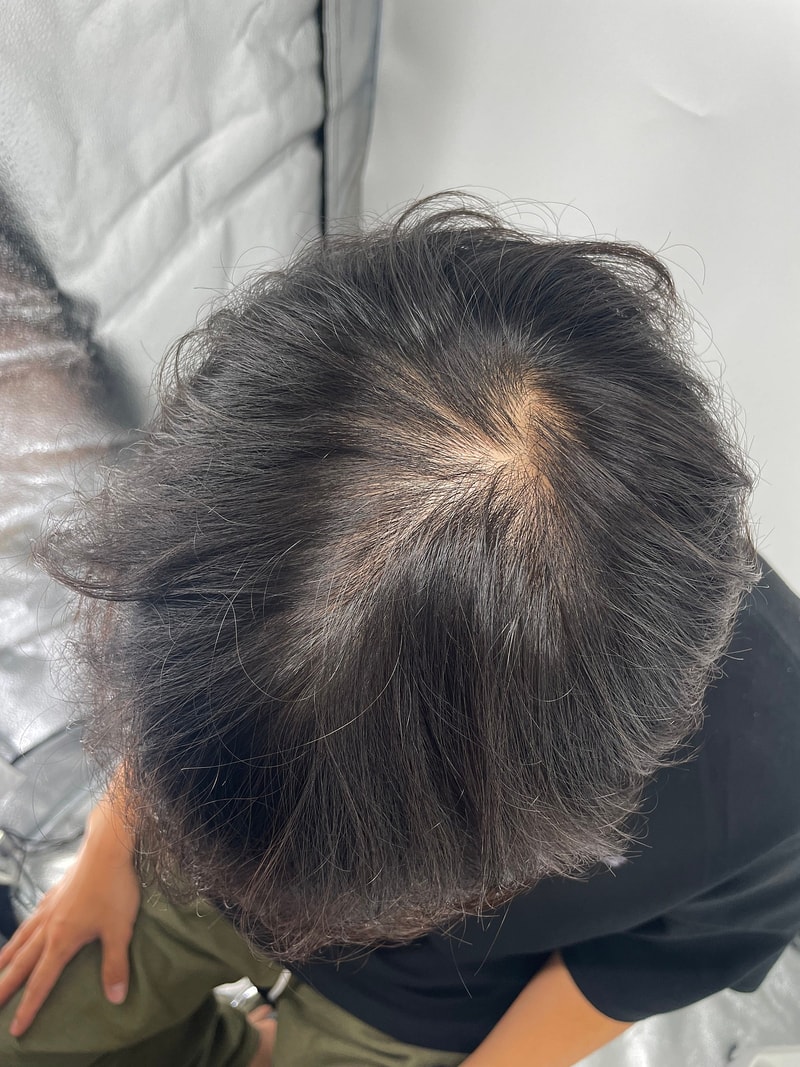 江南新发头皮纹身后期