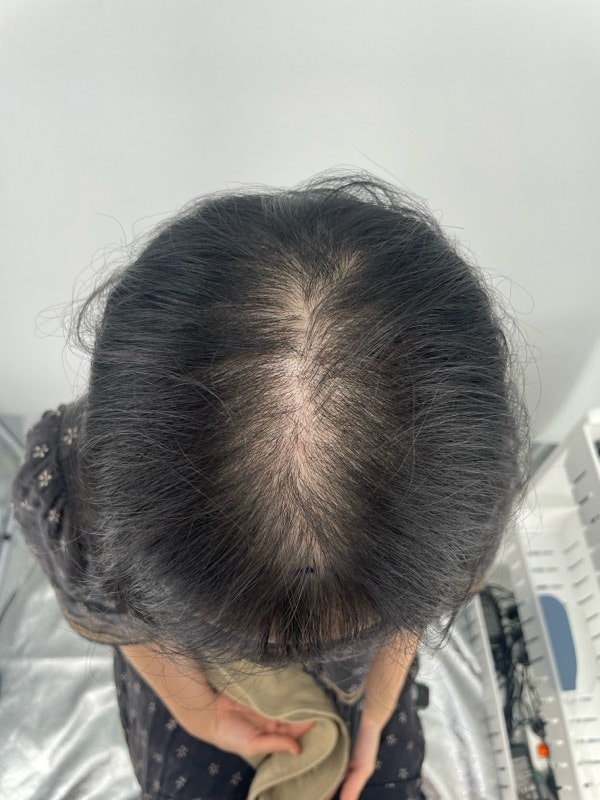 江南新发头皮注射+SMP纹身后记！