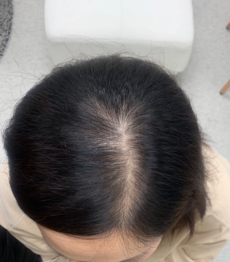 SMP1次手术后.. 怎么样？