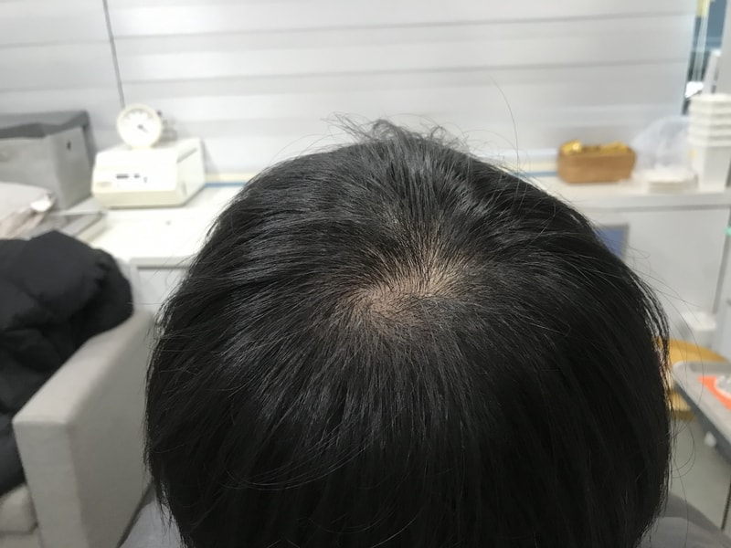 정수리 수지침기법 후기입니다