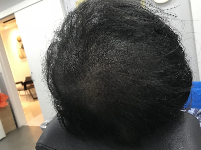 2차시술결과_사진2