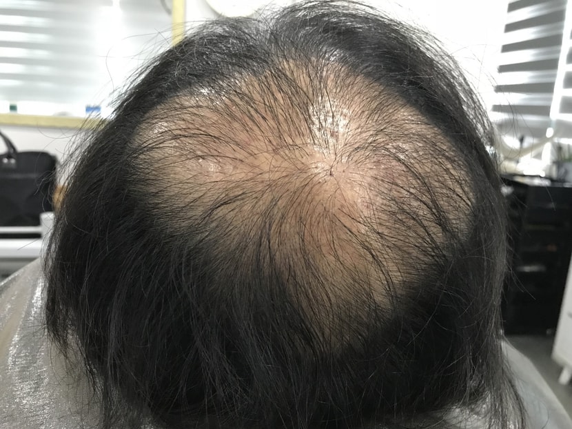 2차시술전_사진2