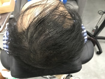 2차시술결과_사진1