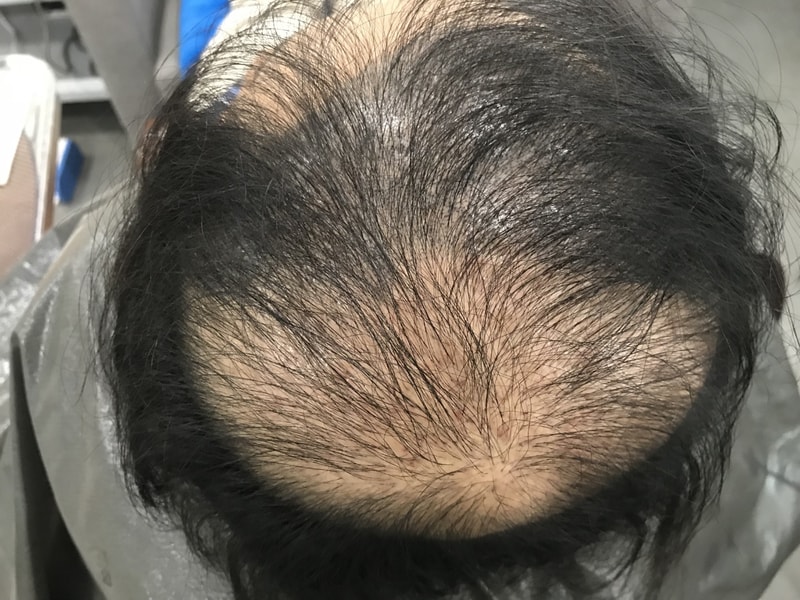 광범위한 두피문신 2차 후기