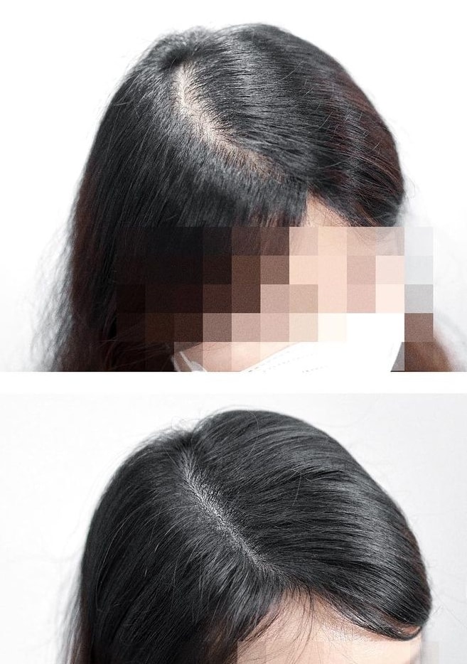 두피문신 8차로완성했네요
