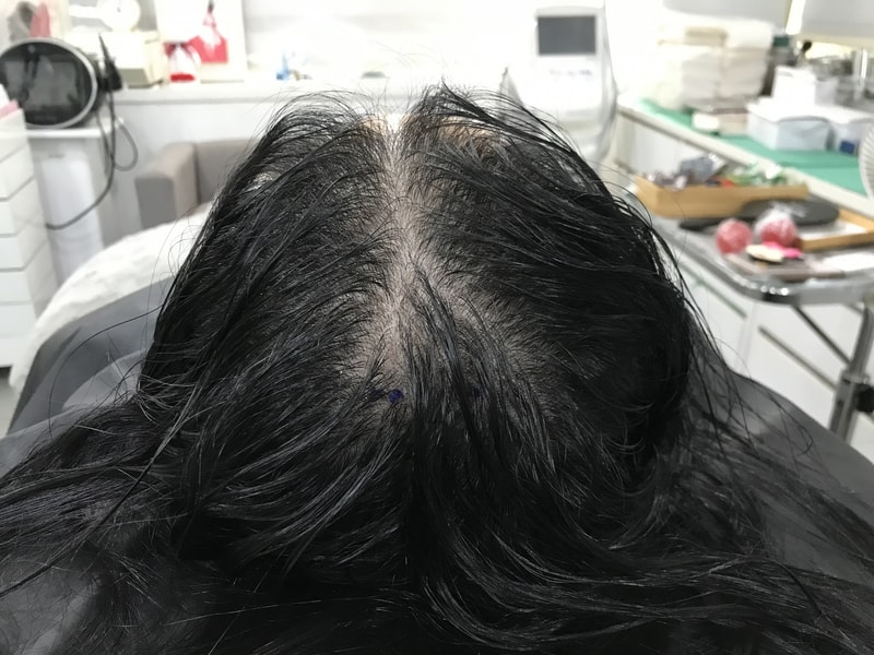 [头皮纹身] 这是头皮纹身后记