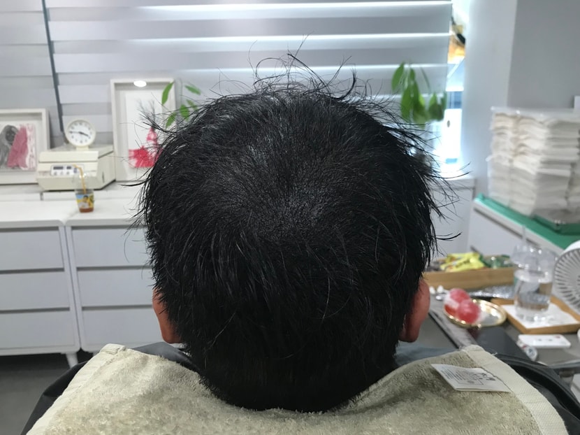 시술후