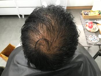 시술전