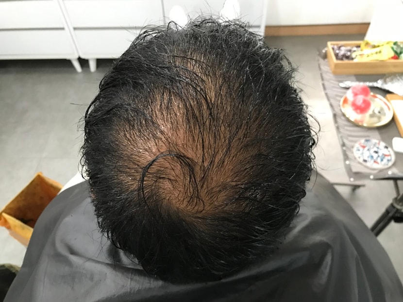 시술전