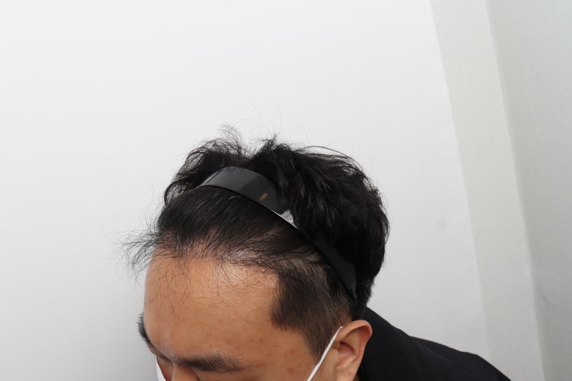 모발이식 6개월차 사진입니다 밀도 부족한거 보이시죠.. 1년차 사진이없는데 1년차에도 밀도가 부족하고 머리에 힘이없어서 휑해보였죠 머리카락은 꼬불꼬불..