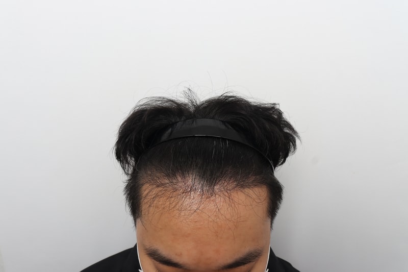 植毛後、頭皮を刺しました