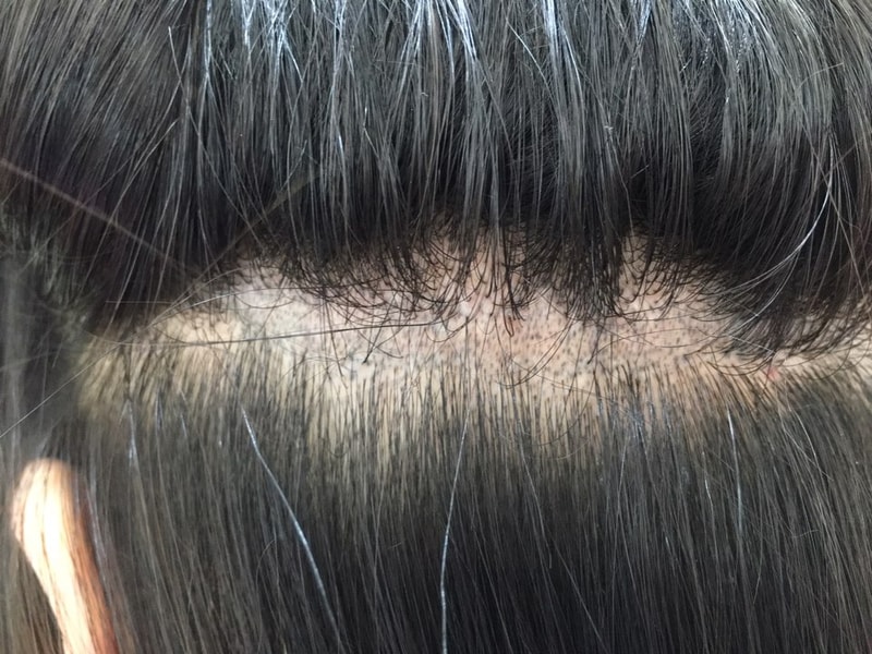 带来了1年后的疤痕头皮纹身后记~~~