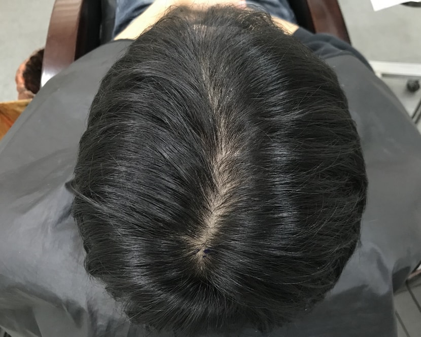 시술 전
