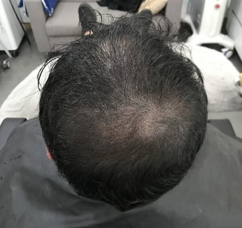 시술 후