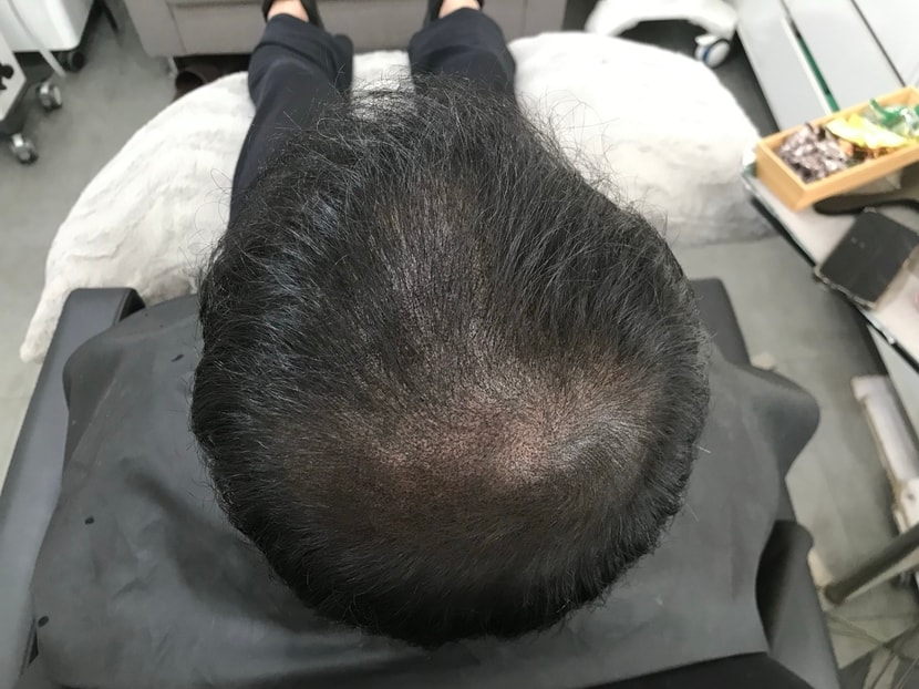 시술 후