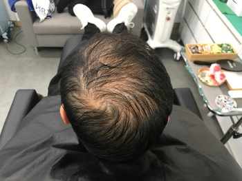 시술전