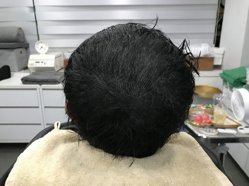 두피문신(직후)