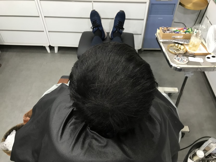 두피문신(직후)
